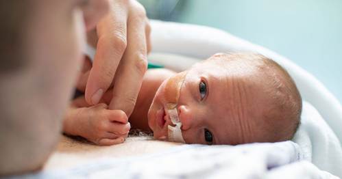 Premature baby lying in a hospital bed with a feeding tube.