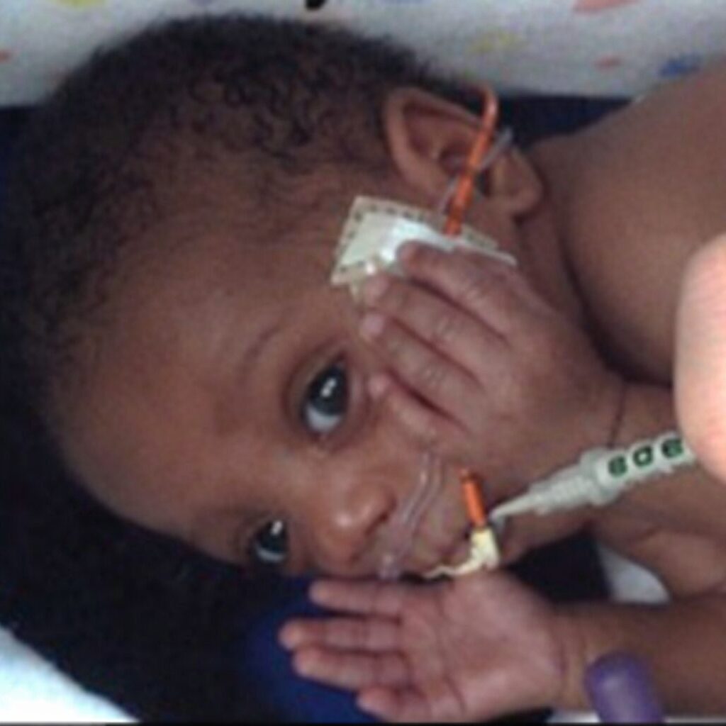 A newborn baby receiving medical care with a feeding tube.